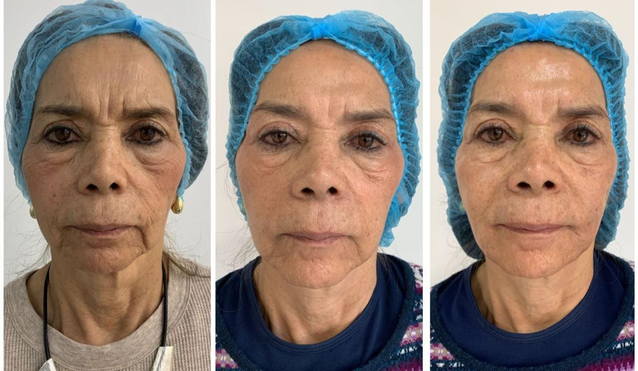 Antes y después real · Rejuvenecimiento facial progresivo · Radiant Skin Bogotá