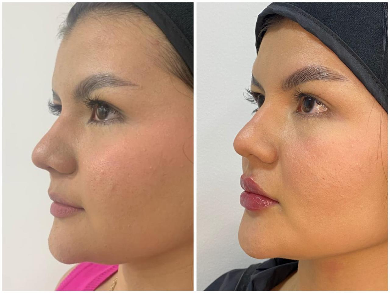 Antes y después real · Labios naturales · Radiant Skin Bogotá