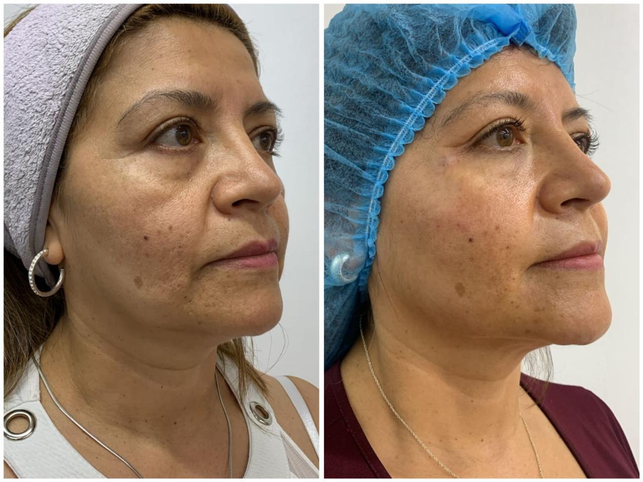 Antes y después real · Firmeza y calidad de piel · Radiant Skin Bogotá
