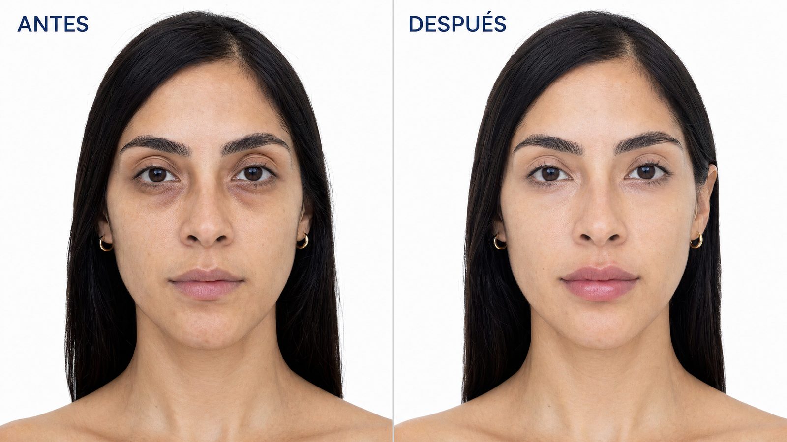 Ácido Hialurónico en Bogotá · Labios · volumen natural