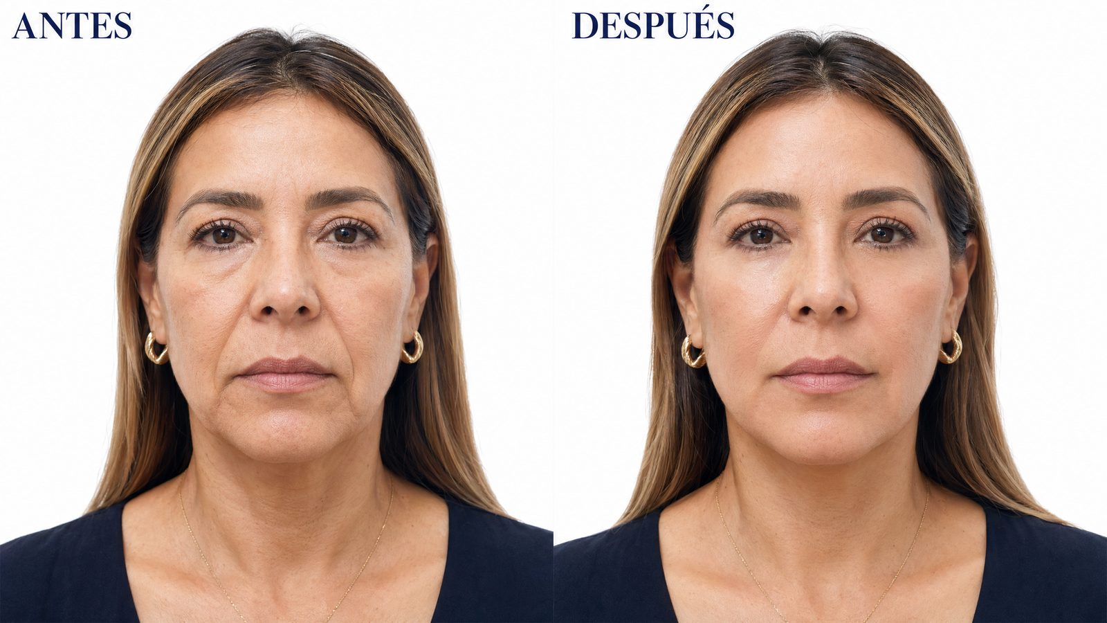 Sculptra y Radiesse en Bogotá · Radiesse · soporte y colágeno