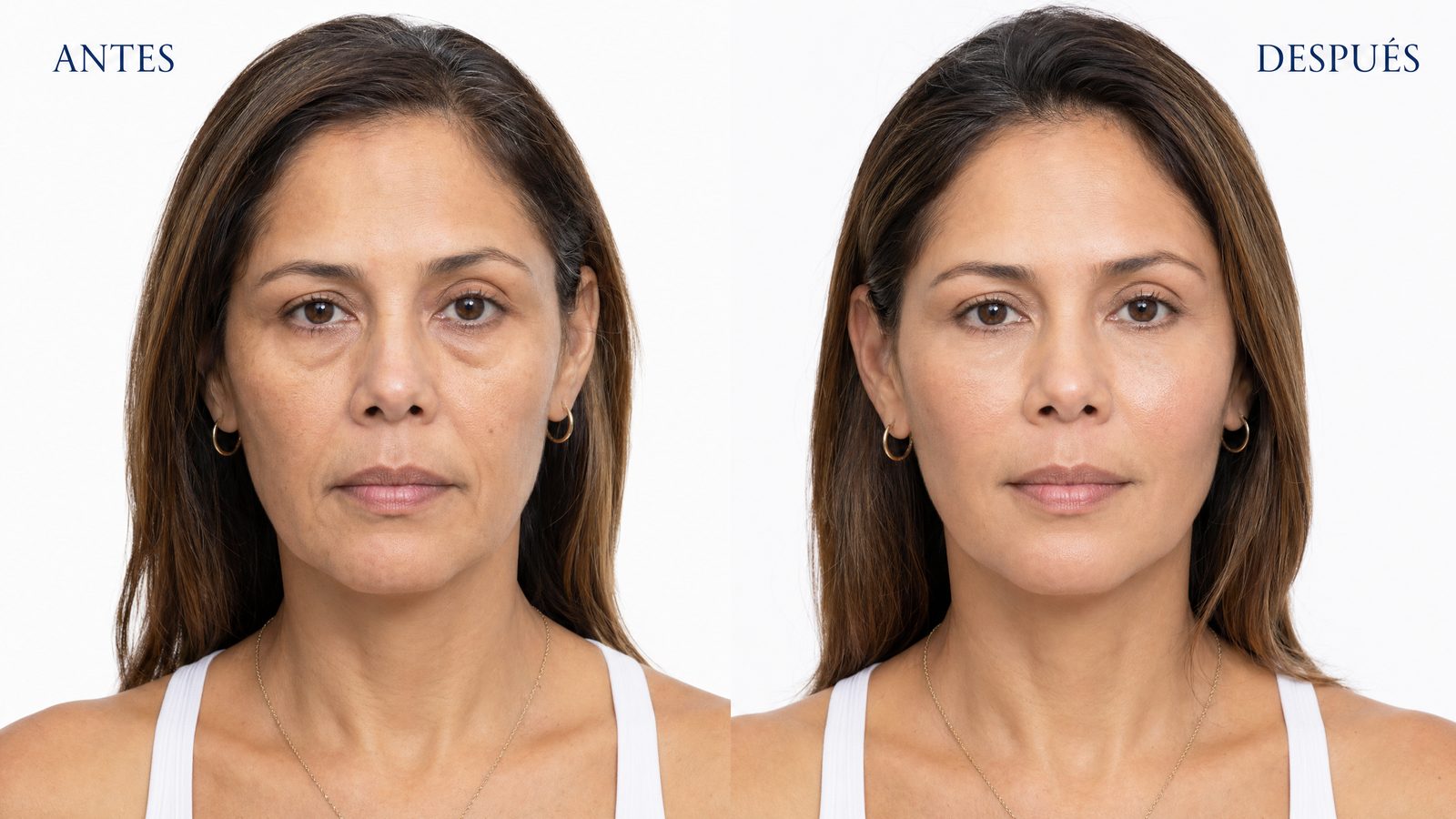 Sculptra vs. Radiesse: cuál elegir según tu edad y tu piel