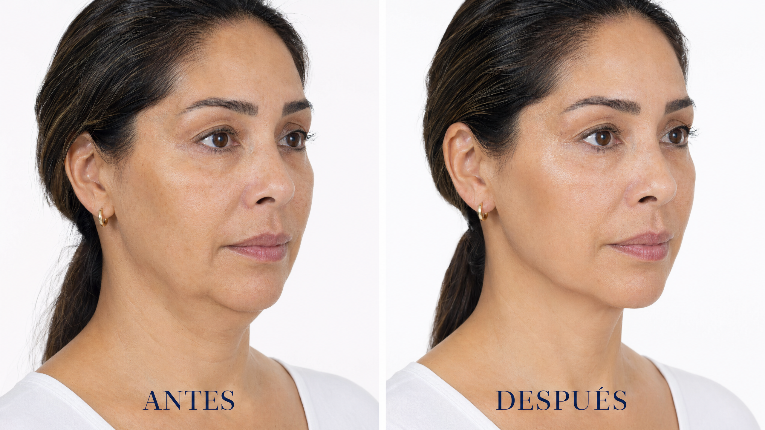 Lifting facial · Cuello y mandíbula