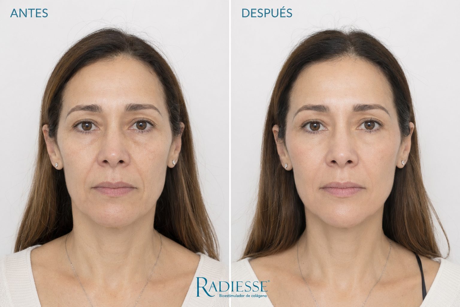 Sculptra y Radiesse en Bogotá · Mandíbula y pómulos