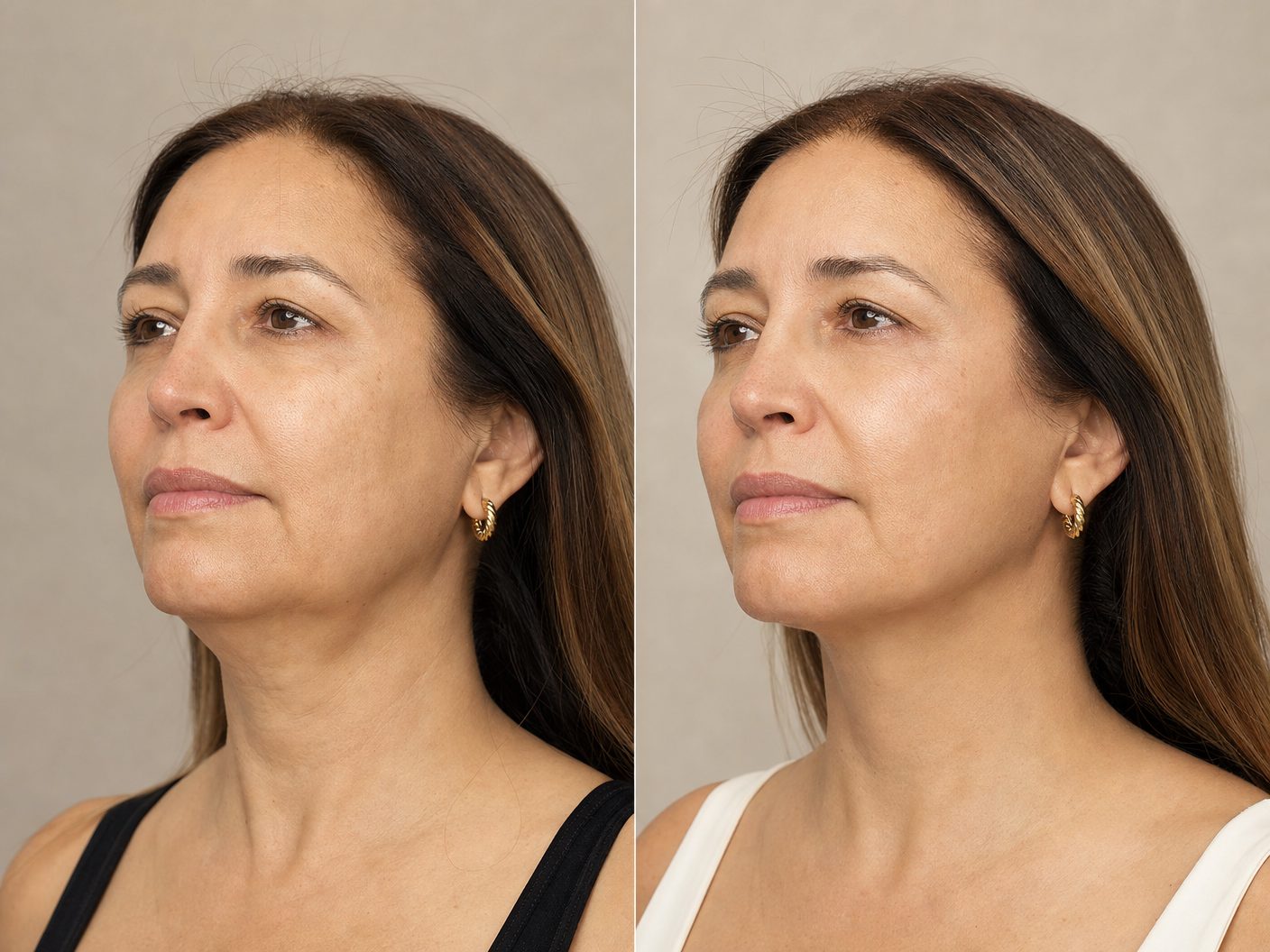 Ultherapy PRIME resultados